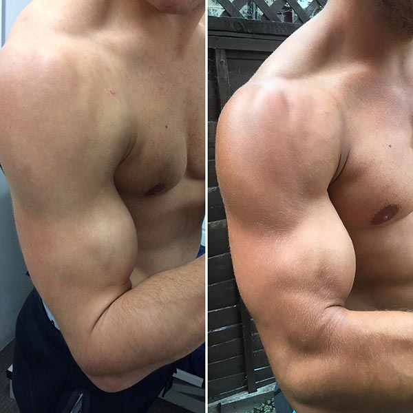 Mike 3 months after surgery (left) and 6 weeks later (right)