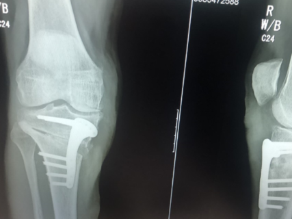 Peter's osteotomy x-ray