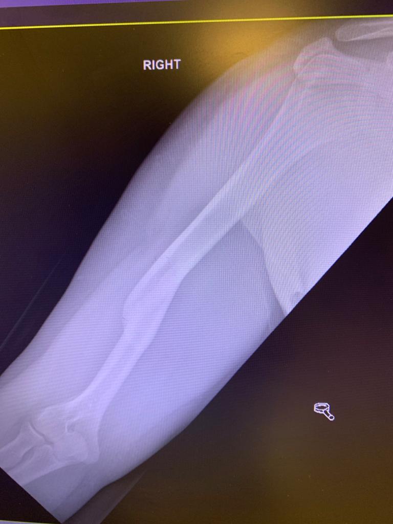 X-ray showing Ravi's right arm post treatment