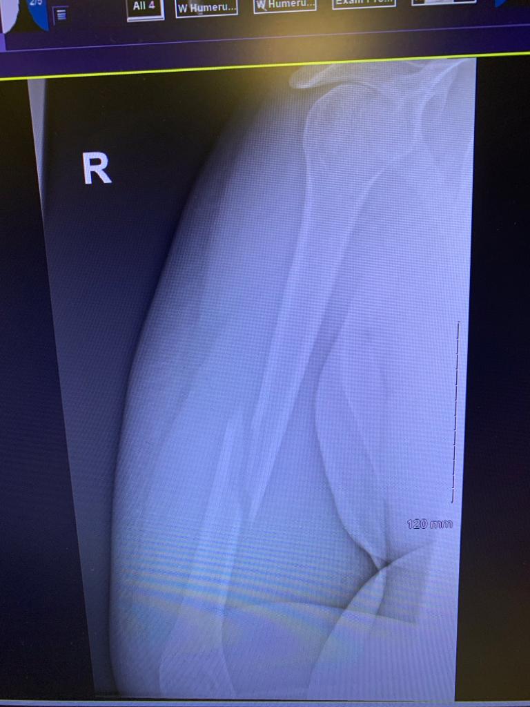 X-ray showing Ravi's right midshaft humerus fracture