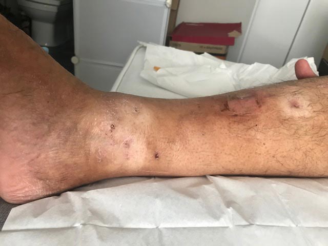 Man's leg in hospital after supportive frame has been removed