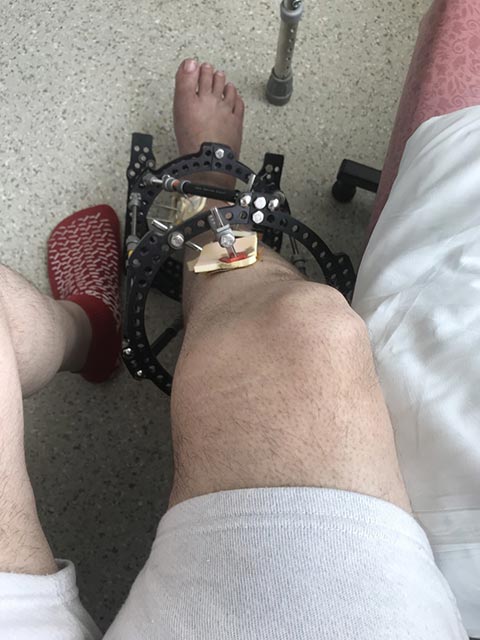Man's leg in supportive frame after surgery