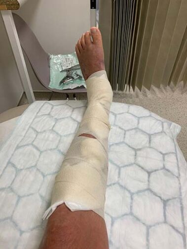 Tom's leg in bandages
