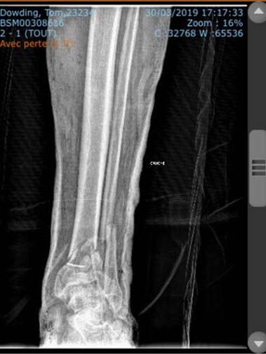 x-ray of Tom's leg