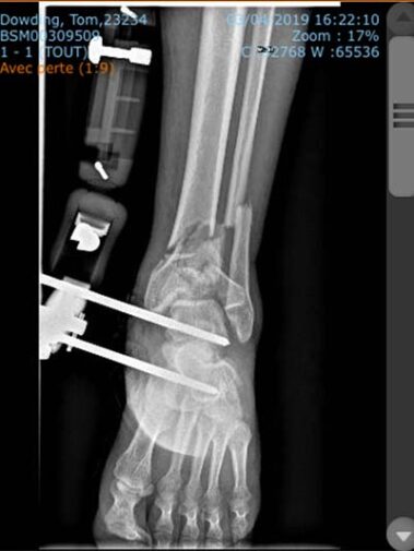 x-ray of Tom's leg