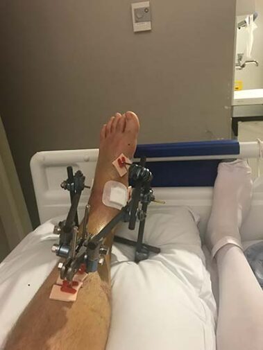 Tom's leg in hospital