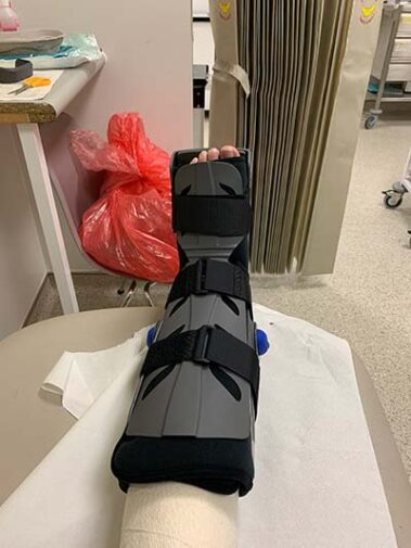 Tom's leg in hospital