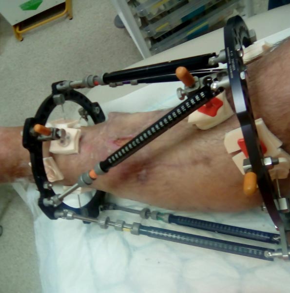 Darrel’s leg encased in a metal frame to keep it in position while healing