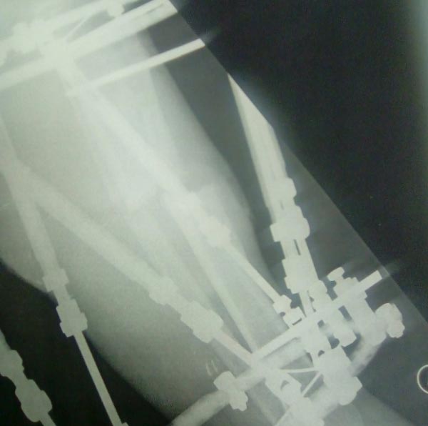 X-ray showing the frame attached to Darrel’s leg