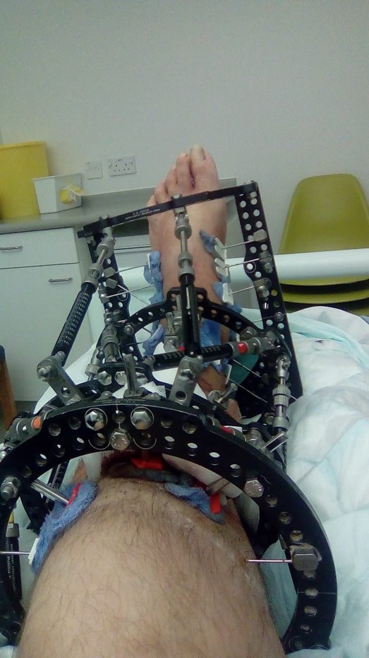 Darrel’s leg with the Taylor Spacial frame, which remained on his leg for many months