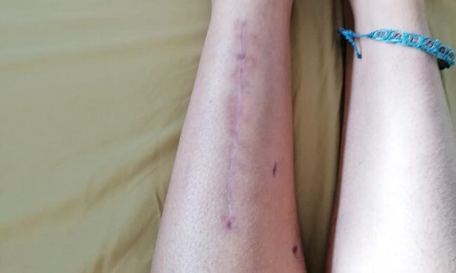 Leg after surgery showing scar