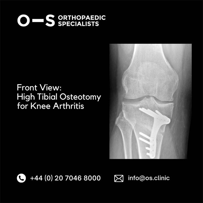 Front View Xray: High Tibial Osteotomy for Knee Arthritis