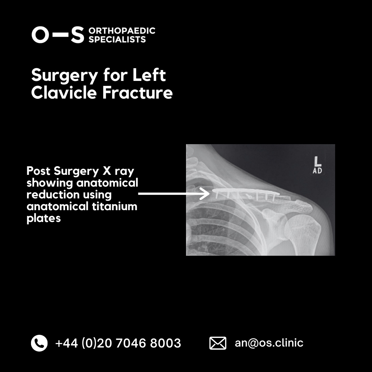 Post-surgery xray - surgery for left clavicle fracture