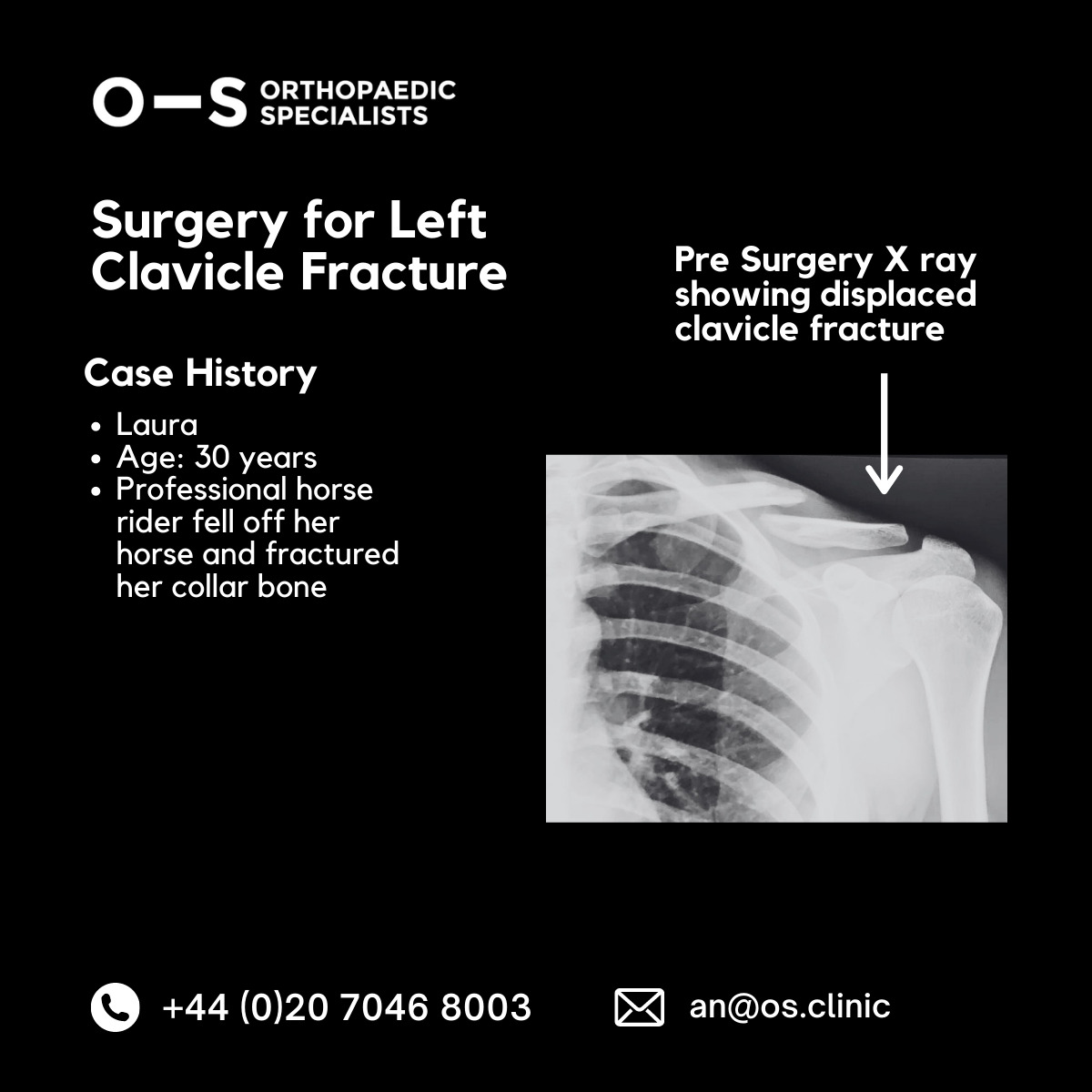 Pre-surgery xray - surgery for left clavicle fracture