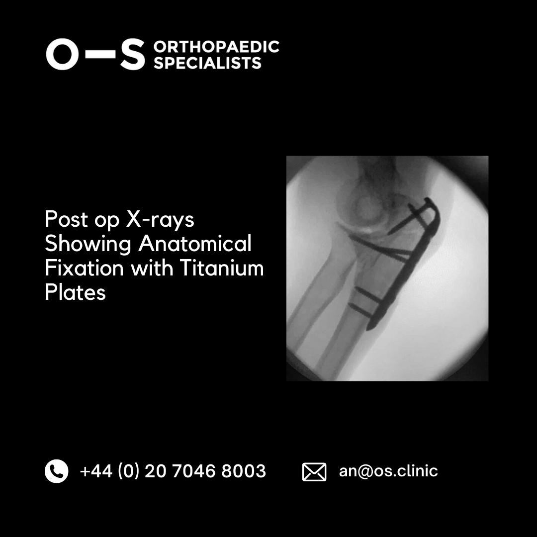 Kate Post op X-rays showing Anatomical Fixation with Titanium Plates