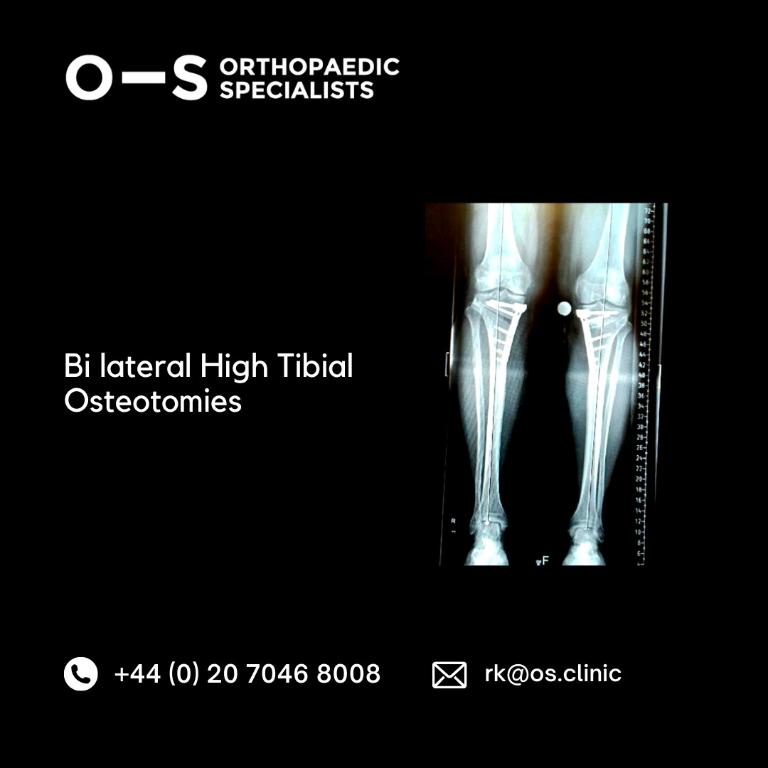 x ray of Bi lateral high tibial osteotomies