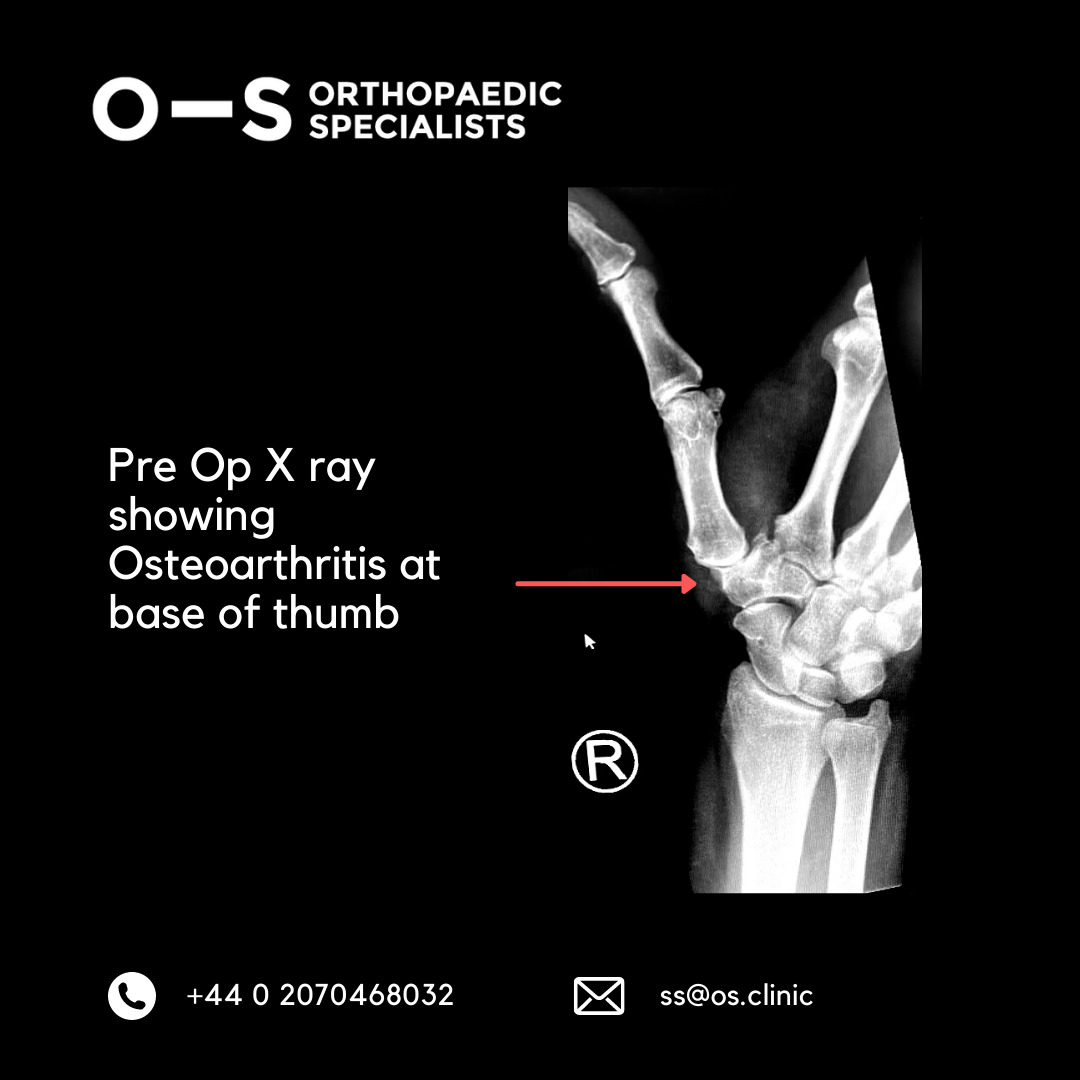 Pre Op X ray showing Osteoarthritis at base of thumb