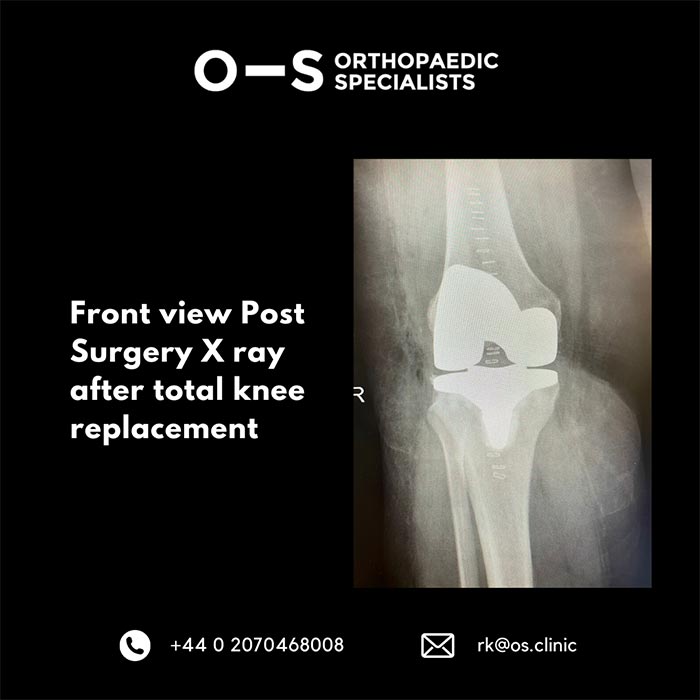 Front view Post Surgery X-ray after total knee replacement