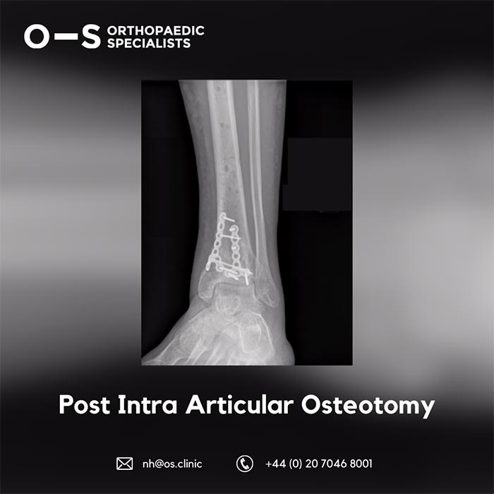 X-ray showing Post Intra Articular Osteotomy