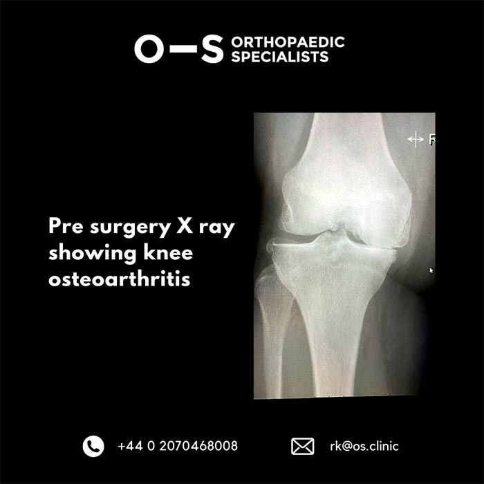 Pre surgery X-ray showing knee osteoarthritis