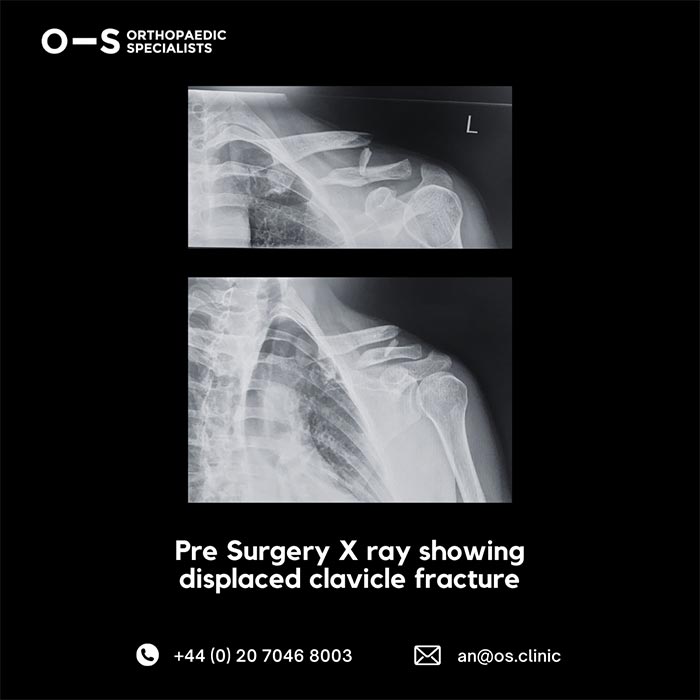 Pre surgery X-ray showing-displaced clavicle fracture
